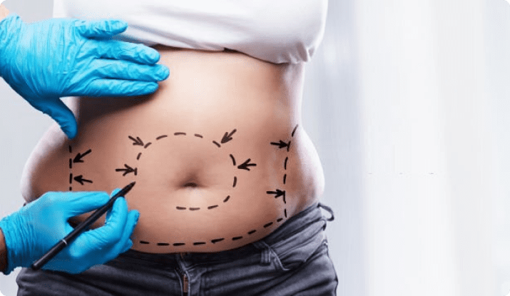 عملية شفط وشد البطن